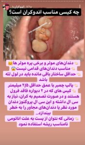 اندوکراون چیست؟ از تراش تا قالبگیری (دکتر رسایی پور) 3 IMG 20230131 220757