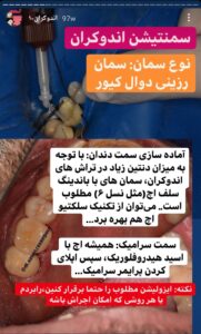 اندوکراون چیست؟ از تراش تا قالبگیری (دکتر رسایی پور) 4 IMG 20230131 221107