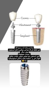 قالبگیری ایمپلنت(هایلایت دکتر نقیبی) 3 2 photo 1674644752 drseyedaminnaghibi RegramBot