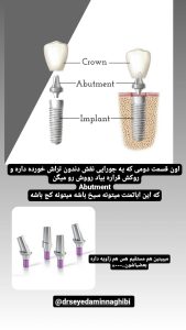 قالبگیری ایمپلنت(هایلایت دکتر نقیبی) 4 3 photo 1674644984 drseyedaminnaghibi RegramBot