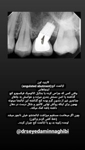 قالبگیری ایمپلنت(هایلایت دکتر نقیبی) 5 4 photo 1674645430 drseyedaminnaghibi RegramBot