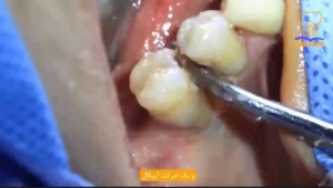 آموزش کشیدن دندان