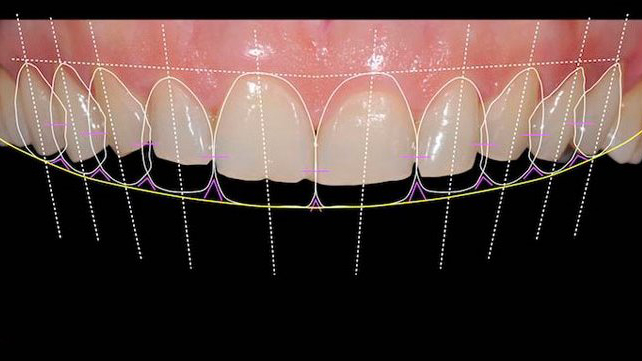 digital smile design1 img