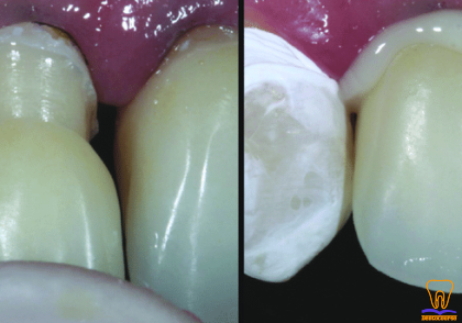 Convention resin cementation of laminate veneers right central and lateral incisors