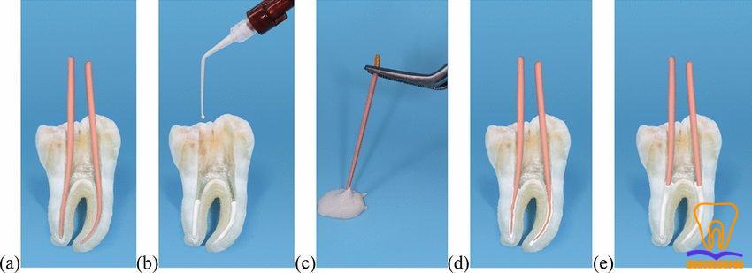 Clinical steps of the single cone obturation technique using flowable HCSB sealer