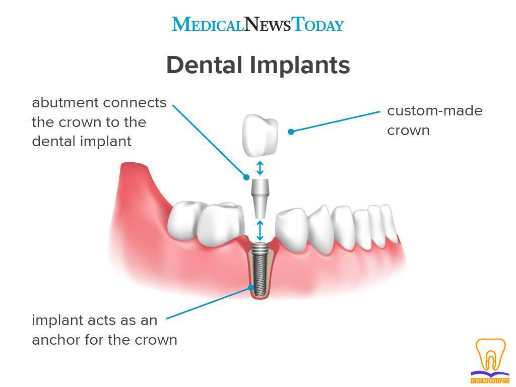 an infographic showing how dental implants work