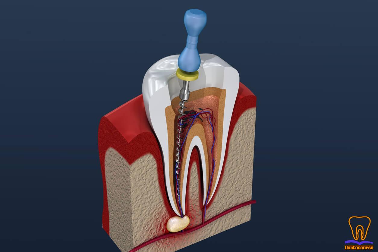 root canal img
