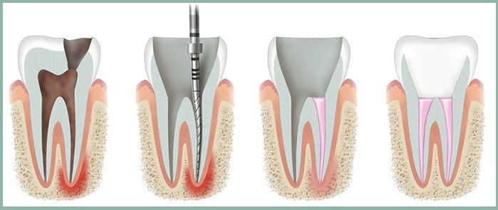 Stages of Root Canal Treatment Steps