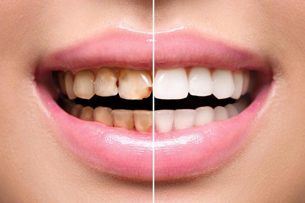 لمینیت های سرامیکی
