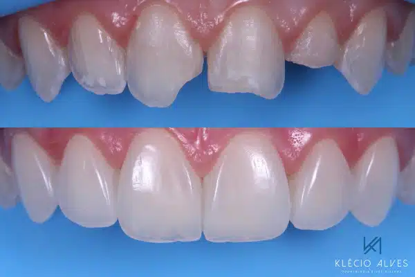Alves Cosmedent Before After 4 600x400 1