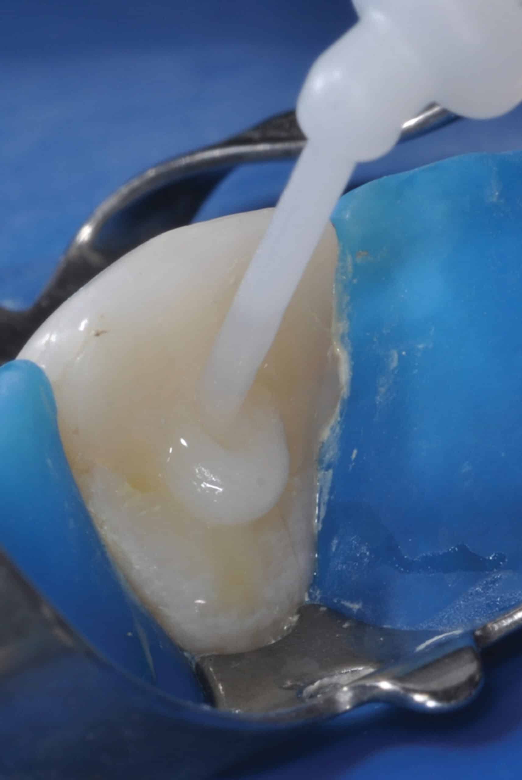 cementation of fiberposts