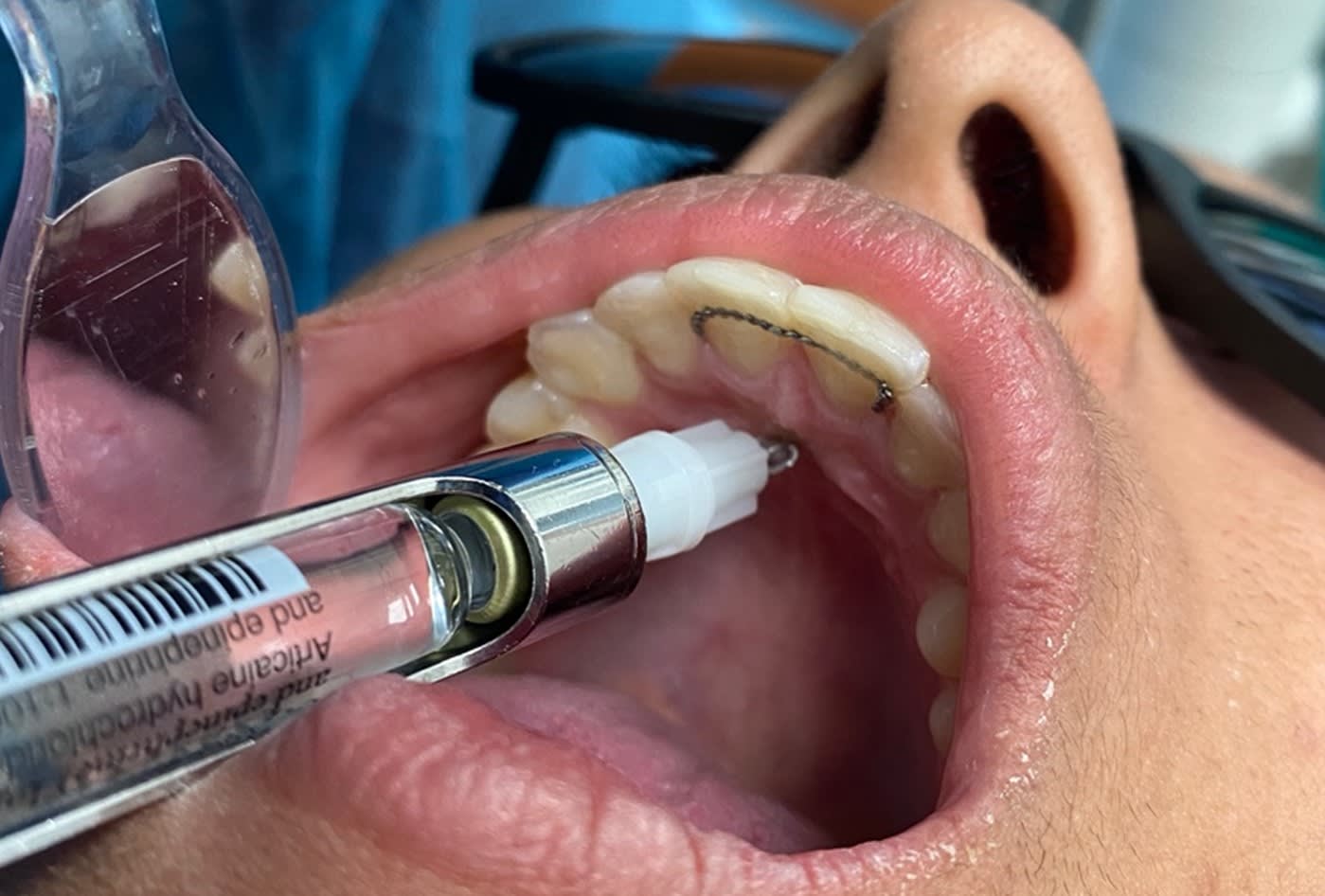 nasopalatine nerve block