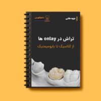 جزوه تراش Onlay