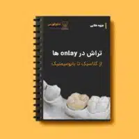 جزوه تراش Onlay