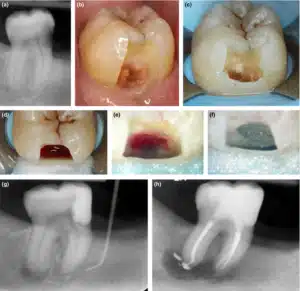 An unsuccessful class II pulp capping. Direct pulp capping class II male 48 years