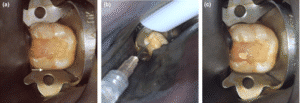 Class I pulp capping. Classical capping approach o