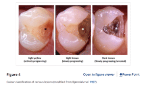 Colour classification of carious lesions modified from Bjorndal et al. 1997