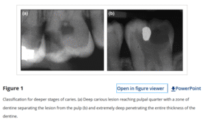 DEEP CARIES