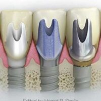Clinical and Laboratory Manual of Dental Implant Abutments