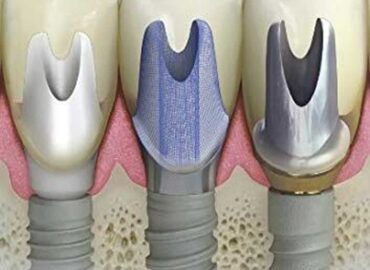 Clinical and Laboratory Manual of Dental Implant Abutments 1