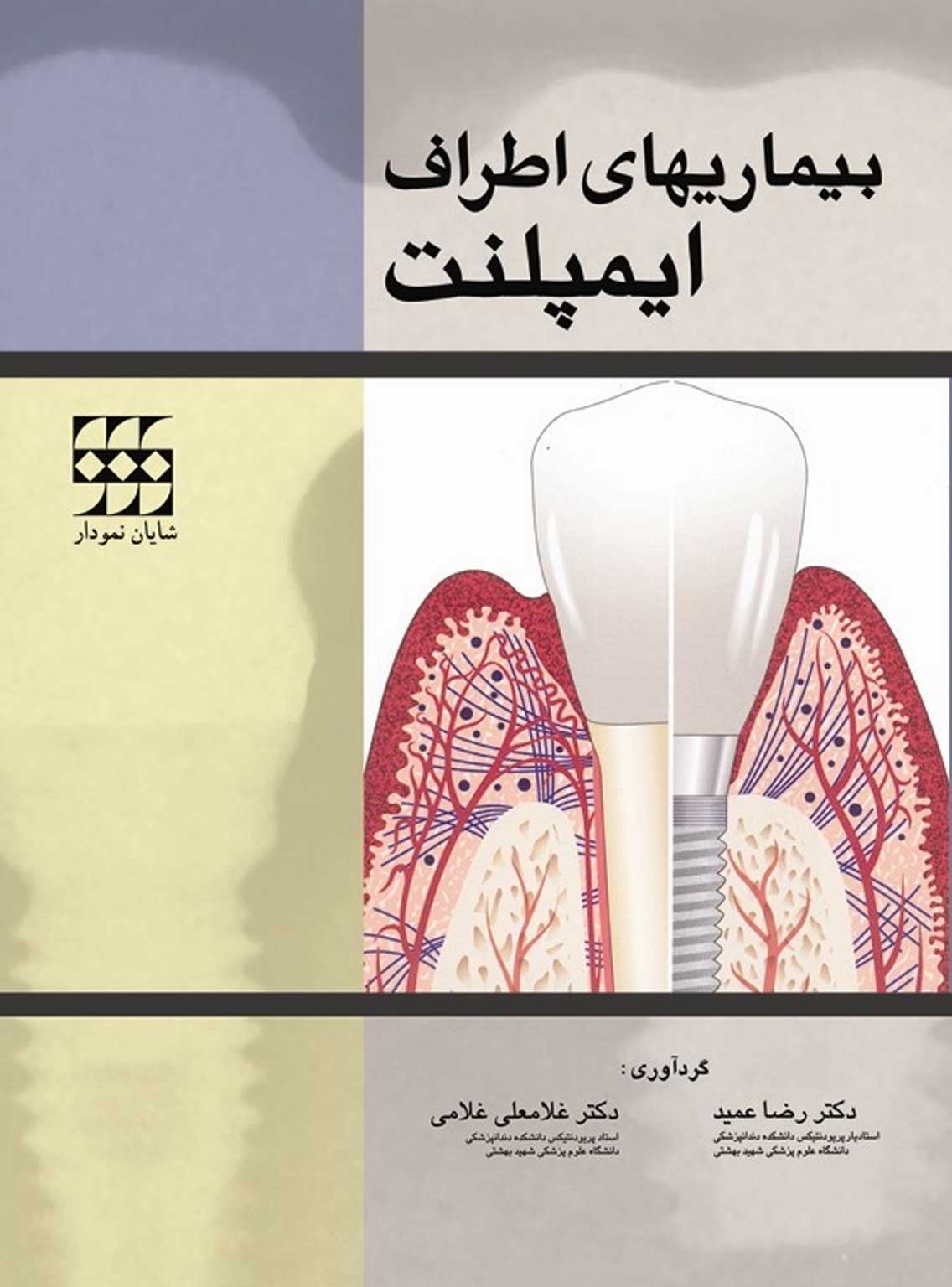 اطراف ایمپلنت
