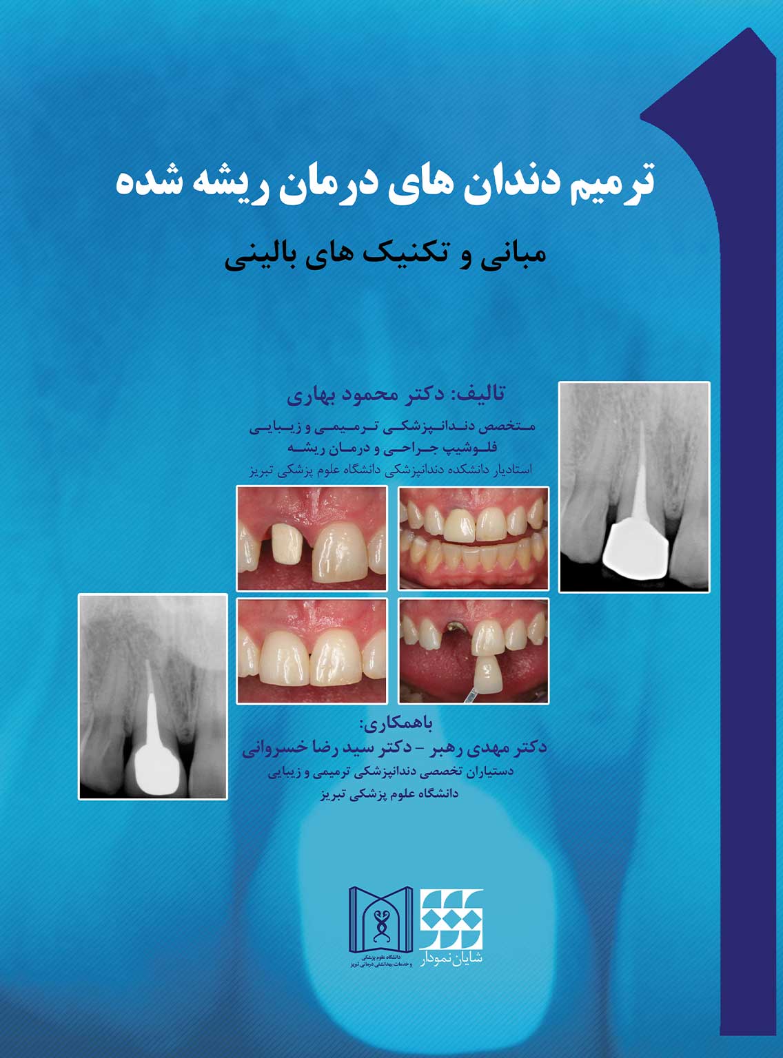 دندان های درمان ریشه شده