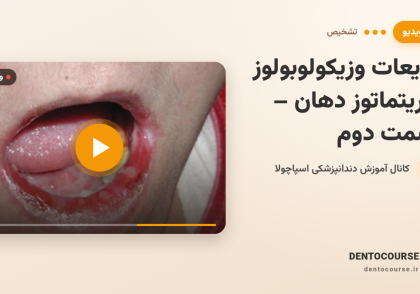 آموزش ضایعات وزیکولوبولوز و اریتماتوز دهان | تشخیص و افتراق بالینی (قسمت دوم)