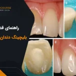 بلیچینگ دندان اندوشده