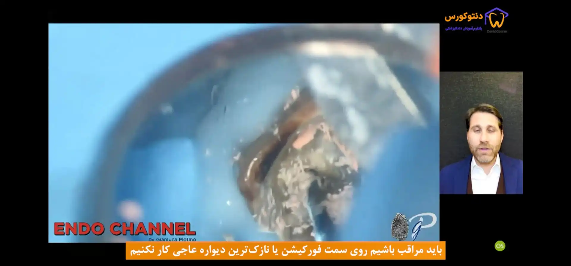 خارج کردن گوتاپرکا