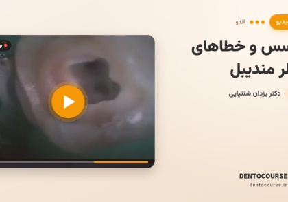 30 access molar mandibular