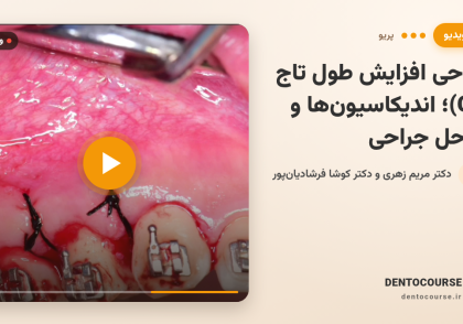 34 crown lengthening cl