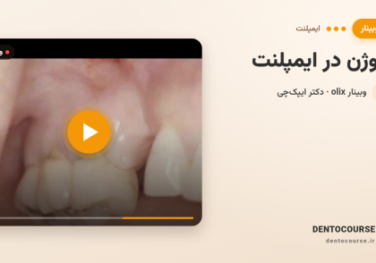 63 occlusal considerations in implants