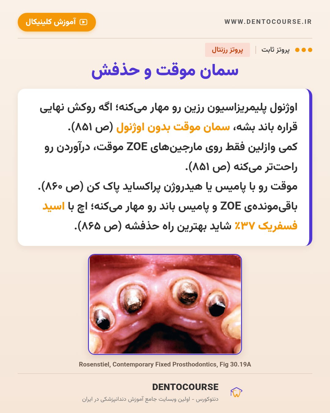 انتخاب سمان در پروتز ثابت؛ راهنمای کامل از پروتز رزنتال (فصل ۳۰) 8 سمان موقت بدون اوژنول و حذف آن