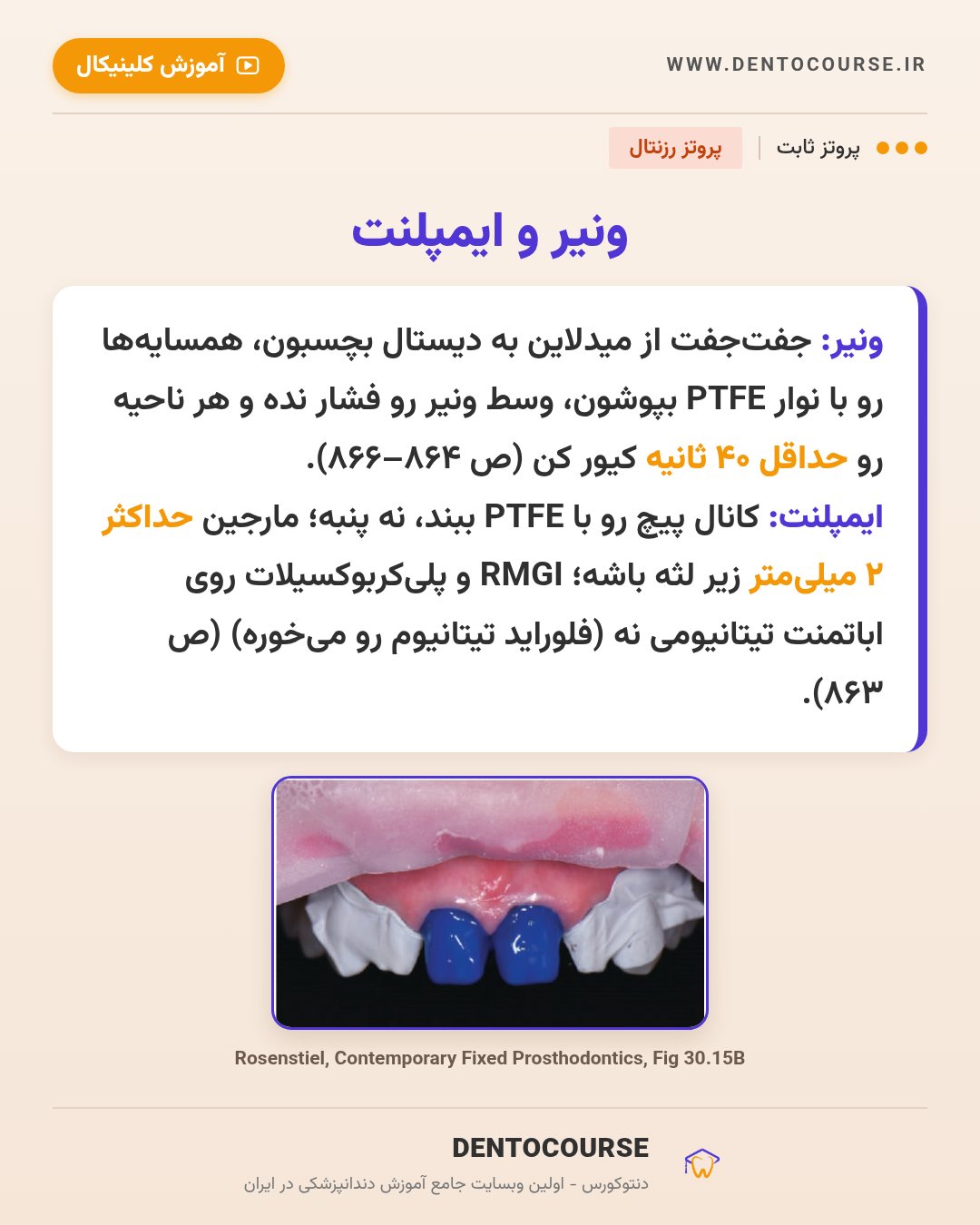 انتخاب سمان در پروتز ثابت؛ راهنمای کامل از پروتز رزنتال (فصل ۳۰) 6 سمان کردن ونیر و روکش ایمپلنت