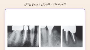 rosenstiel post length featured
