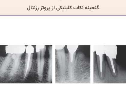 rosenstiel post length featured