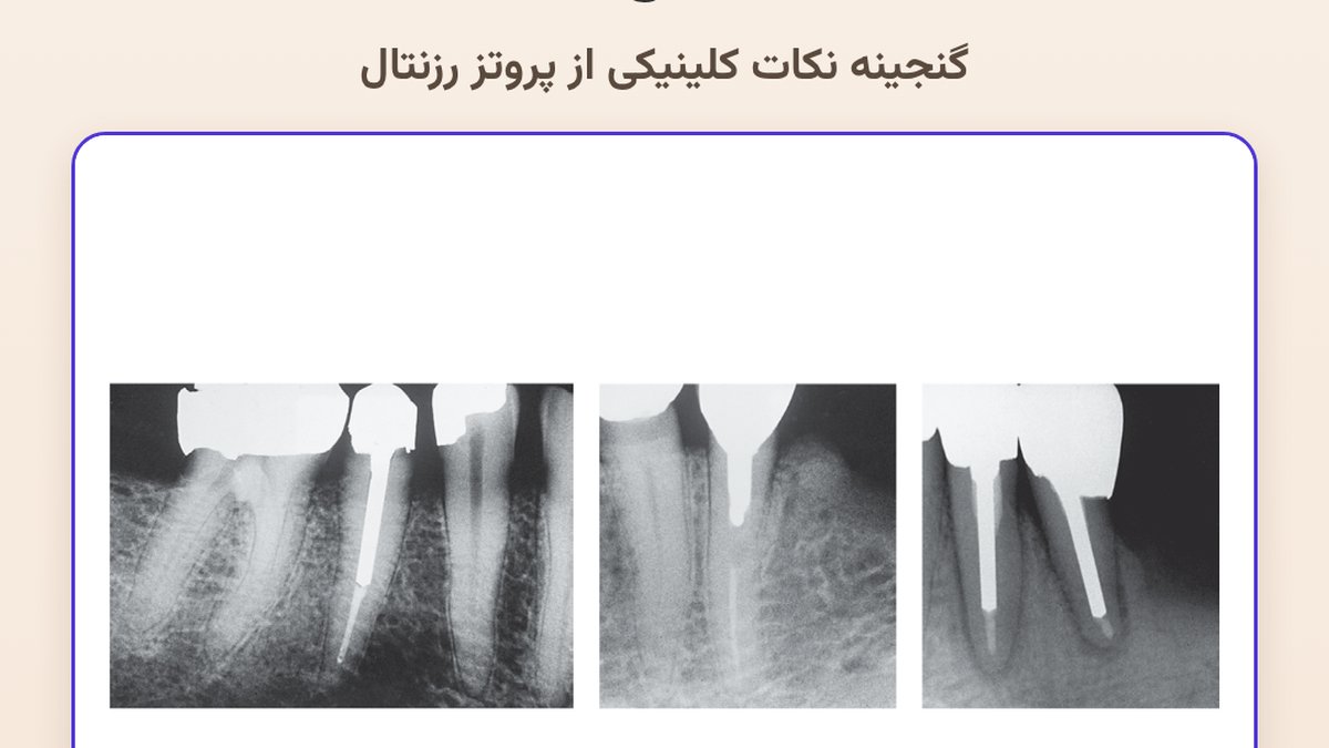 rosenstiel post length featured
