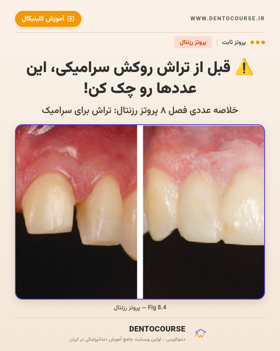 تراش برای رستوریشنهای سرامیکی؛ راهنمای عددی فصل ۸ پروتز رزنتال 2 تراش برای رستوریشنهای سرامیکی؛ خلاصه عددی فصل ۸ پروتز رزنتال