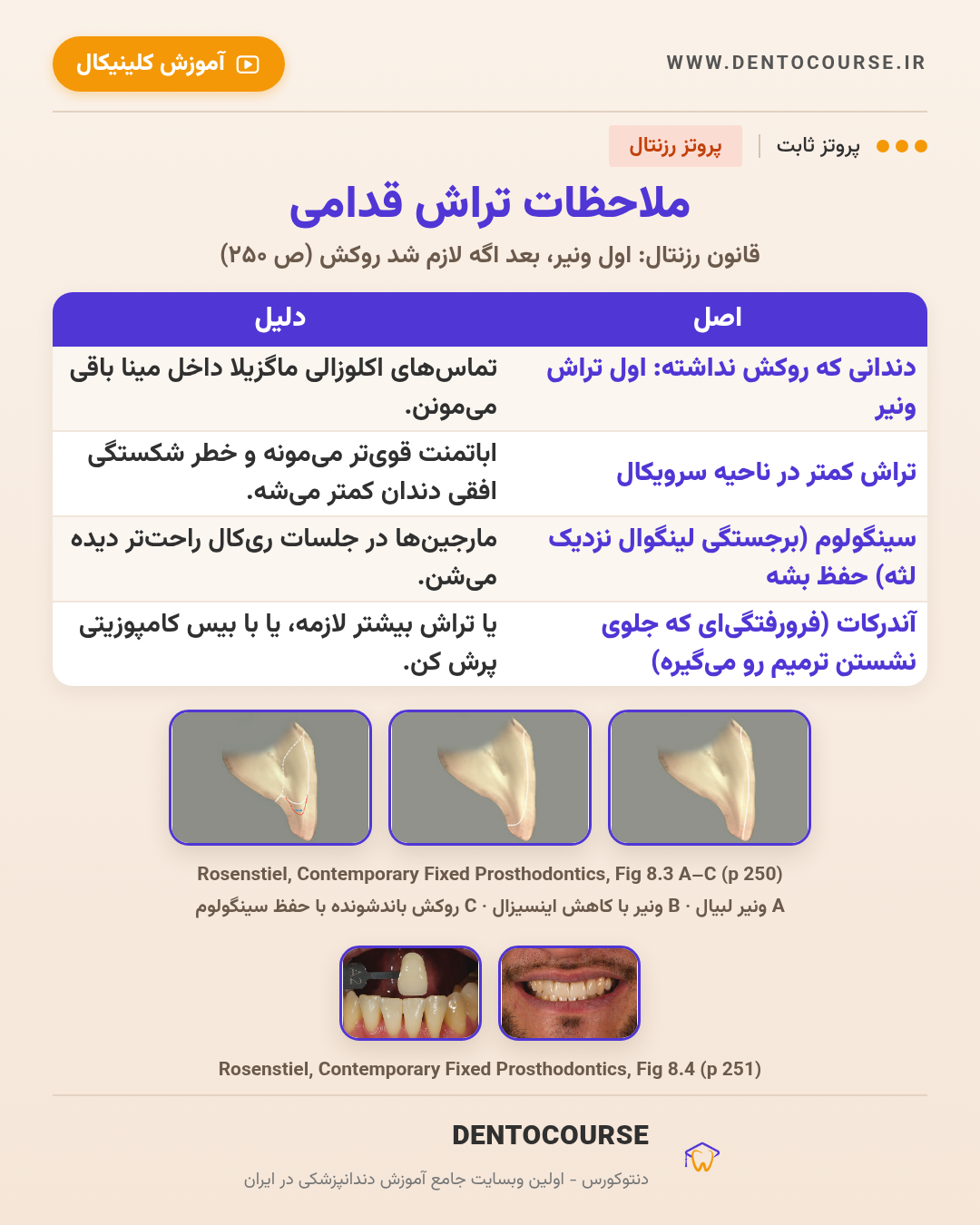 تراش برای رستوریشنهای سرامیکی؛ راهنمای عددی فصل ۸ پروتز رزنتال 4 ملاحظات تراش قدامی برای لمینیت ونیر و روکش سرامیکی باندشونده؛ Fig 8.3 پروتز رزنتال