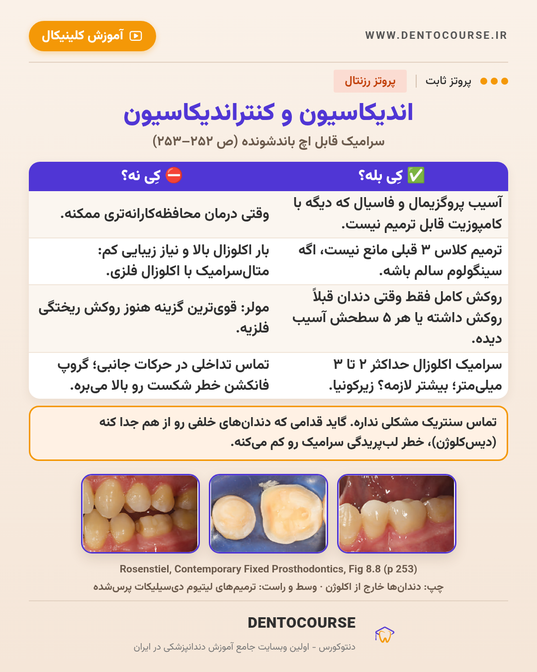 تراش برای رستوریشنهای سرامیکی؛ راهنمای عددی فصل ۸ پروتز رزنتال 6 اندیکاسیون و کنتراندیکاسیون رستوریشن سرامیکی قابل اچ؛ Fig 8.8 پروتز رزنتال