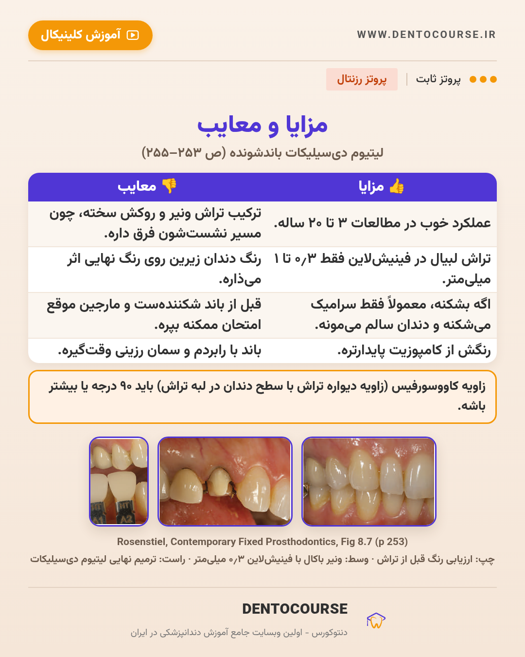 تراش برای رستوریشنهای سرامیکی؛ راهنمای عددی فصل ۸ پروتز رزنتال 7 مزایا و معایب روکش لیتیوم دیسیلیکات باندشونده؛ Fig 8.7 پروتز رزنتال